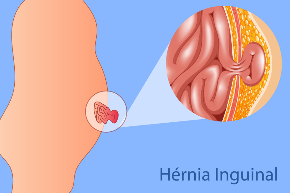 Cirurgião Marcelo Heidrich alerta sobre cuidados em caso de hérnia inguinal